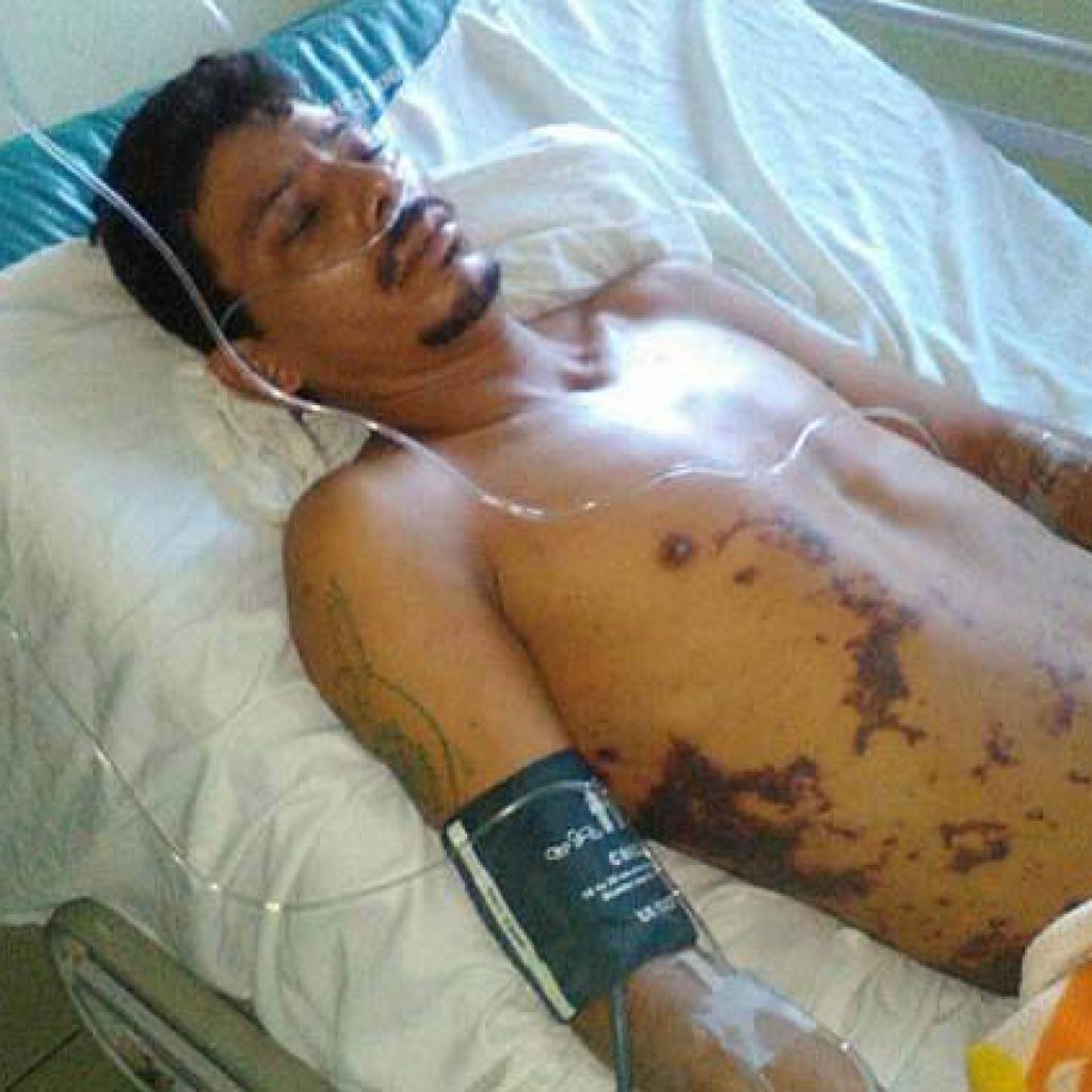 Joven de Matiguás pierde sus piernas por torturas de la Policía Nacional