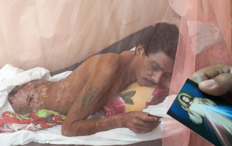 Juan Lanzas curándose de sus heridas en una cama del Hospital de Matagalpa. LA PRENSA / Óscar Navarrete