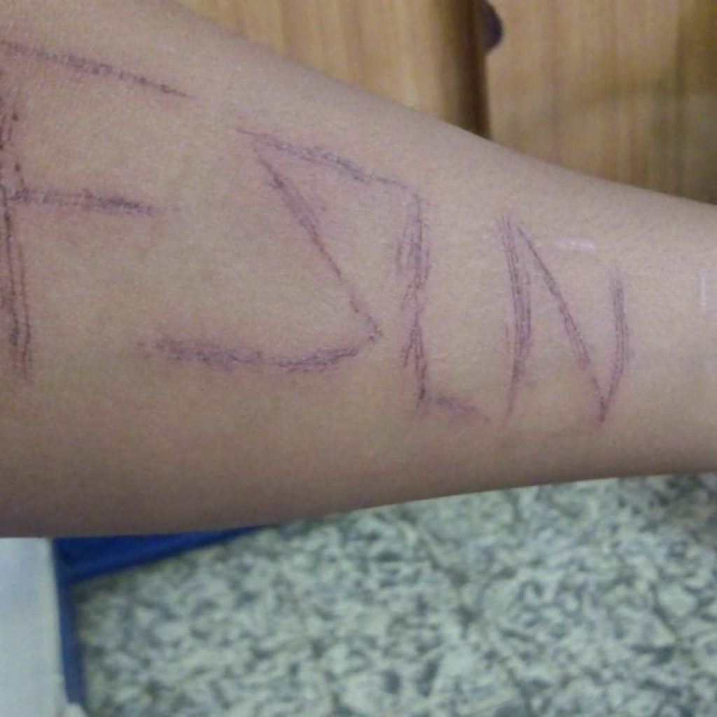 Policía tortura a niño de 14 años y le marcan siglas FSLN en su brazo
