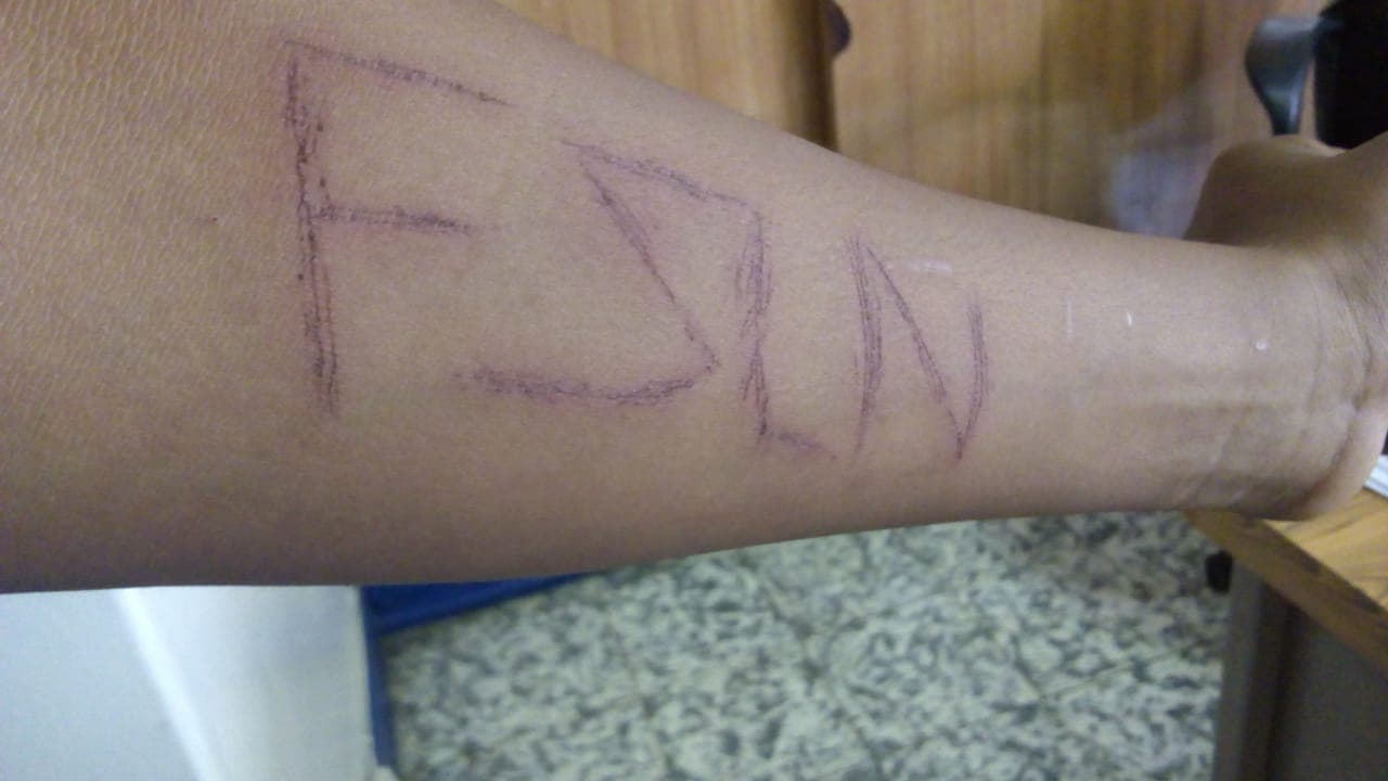 Policía tortura a niño de 14 años y le marcan siglas FSLN en su brazo . Foto: Cortesía