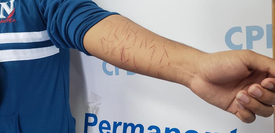 Paramilitares orteguistas golpearon a un adolescente y le marcaron en el brazo la palabra «plomo» y «el comandante se queda». Foto: Geovanny Shiffman/Artículo 66
