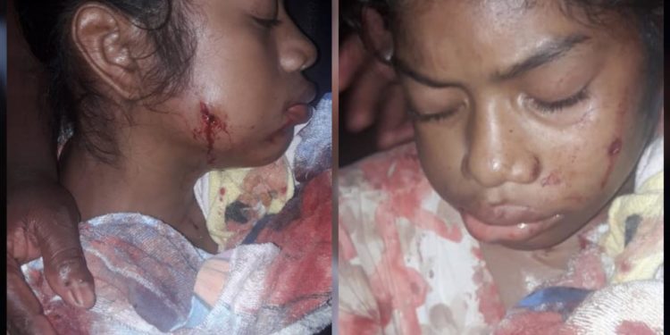 Adolescente de 14 años herida de bala tras nuevo ataque de colonos. Foto: Cortesía