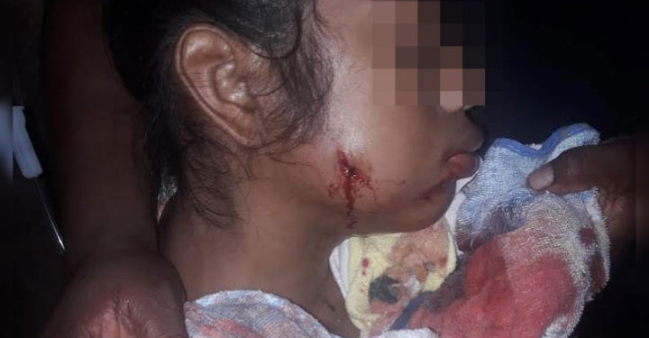 Adolescente recibió impacto de bala en su rostro tras ataque de colonos. Foto: Cortesía