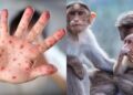 Confirman el primer caso de viruela del mono en Taiwán