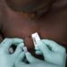 OPS en alerta por incremento de casos de viruela de mono en la región