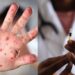 OMS aumenta casos de la viruela del mono en el mundo