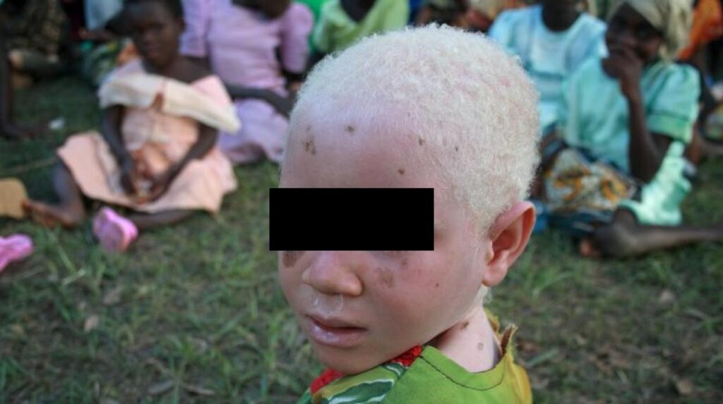 <strong>Un niño albino fue encontrado desmembrado en RD Congo</strong>
