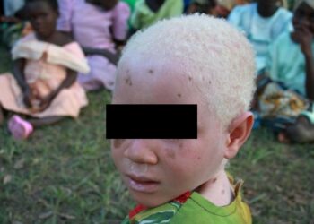 Un niño albino fue encontrado desmembrado en RD Congo