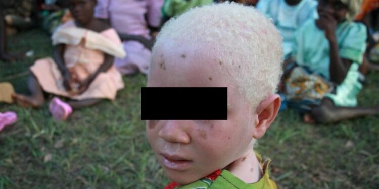 Un niño albino fue encontrado desmembrado en RD Congo