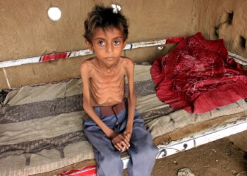 NOTA DEL EDITOR: Contenido gráfico / Hassan Razem, un niño de diez años que sufre de desnutrición aguda grave, aparece en una foto en el distrito de Abs de la provincia noroccidental de Hajjah en Yemen, el 25 de julio de 2022.