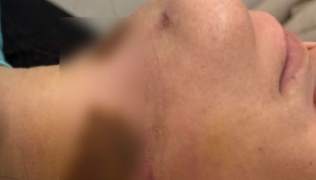 Continúa juicio a médico al que una mujer demandó por una lipopapada que salió mal